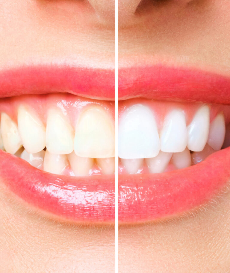 Clareamento Dental em Laranjeiras clareamento dental antes e depois