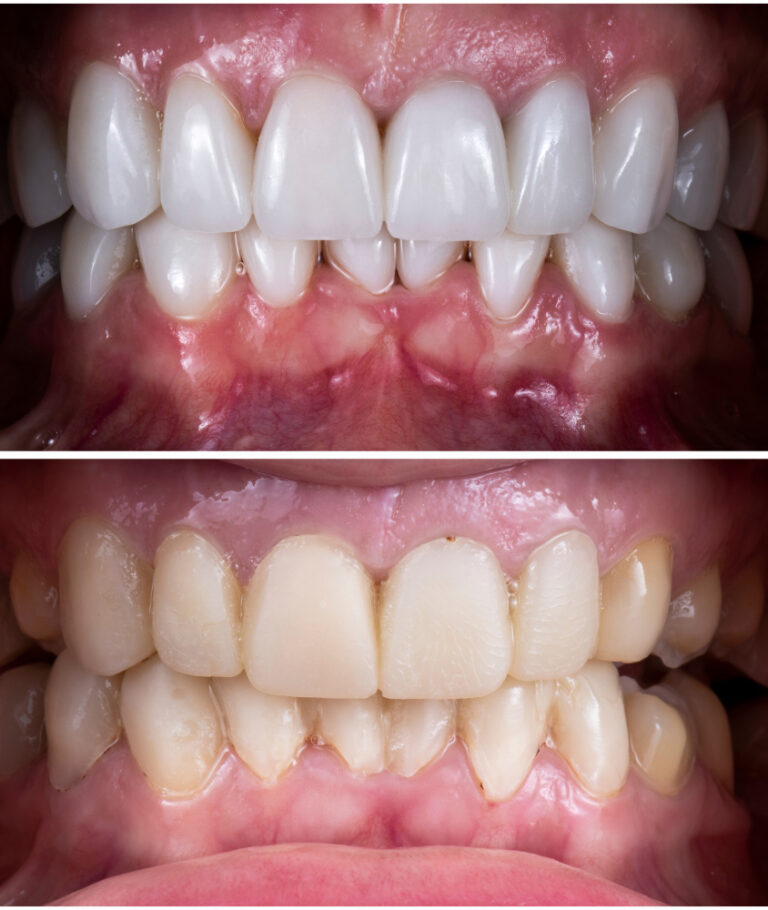 Facetas de Porcelana em Laranjeiras faceta de porcelana antes e depois