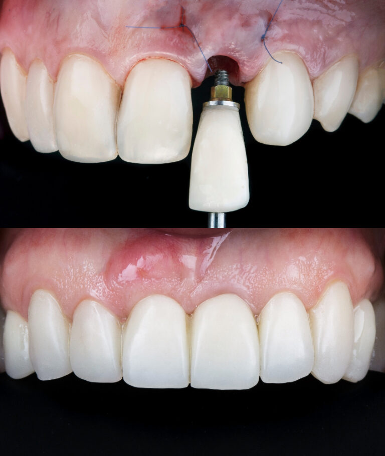 Implante Dentário em Laranjeiras implante dentário antes e depois