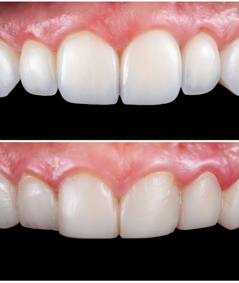 Lentes de Contato Dental em Laranjeiras lentes de contato dental antes e depois