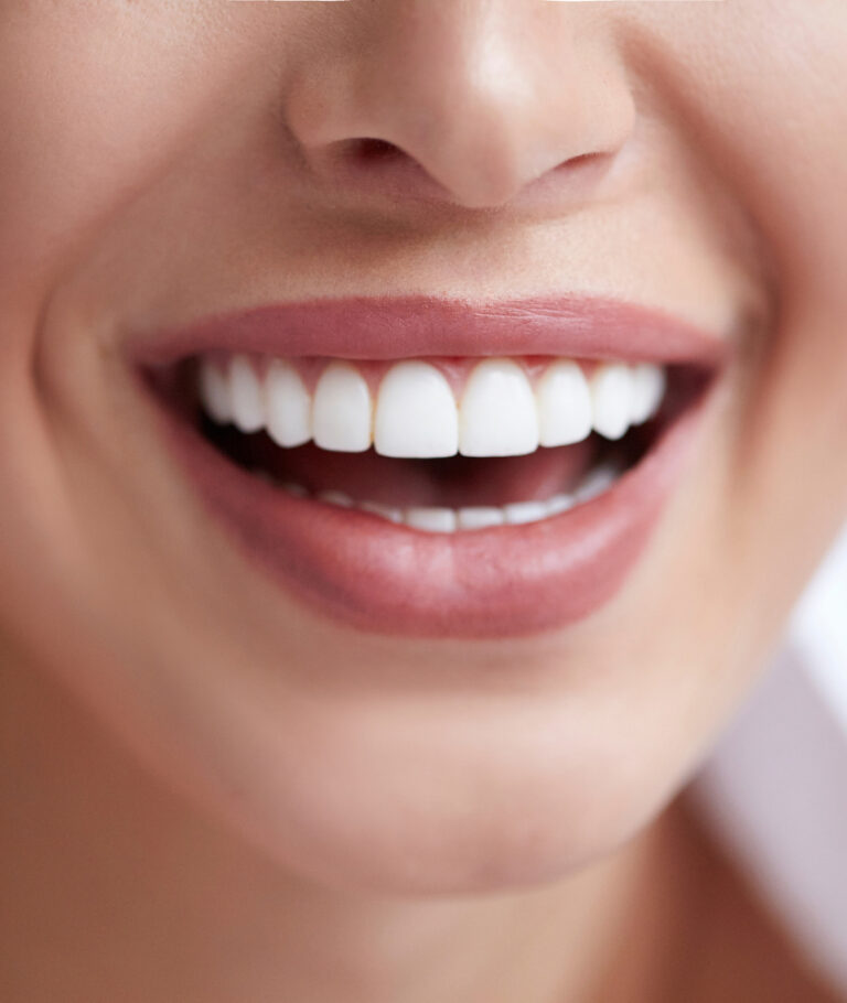 Lentes de Contato Dental em Laranjeiras lentes e contato dental