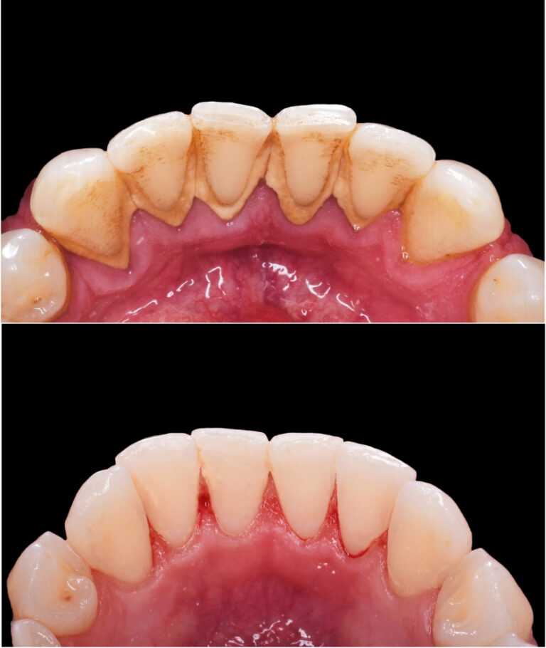 Limpeza nos Dentes em Laranjeiras limpeza dental antes e depois
