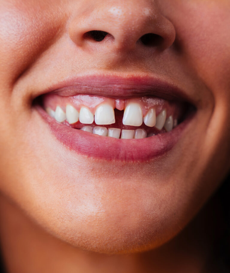 Fechamento de Diastema em Laranjeiras o que é diastema