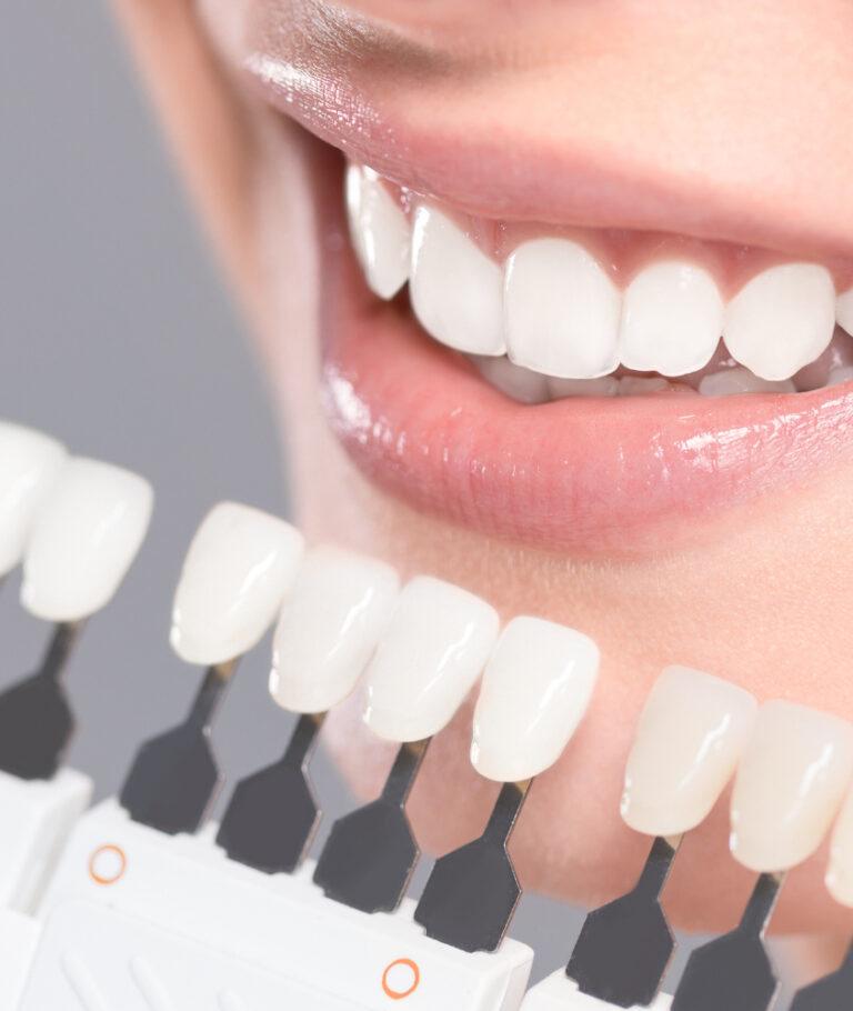 Lentes de Contato Dental em Laranjeiras o que é lente de contato dental